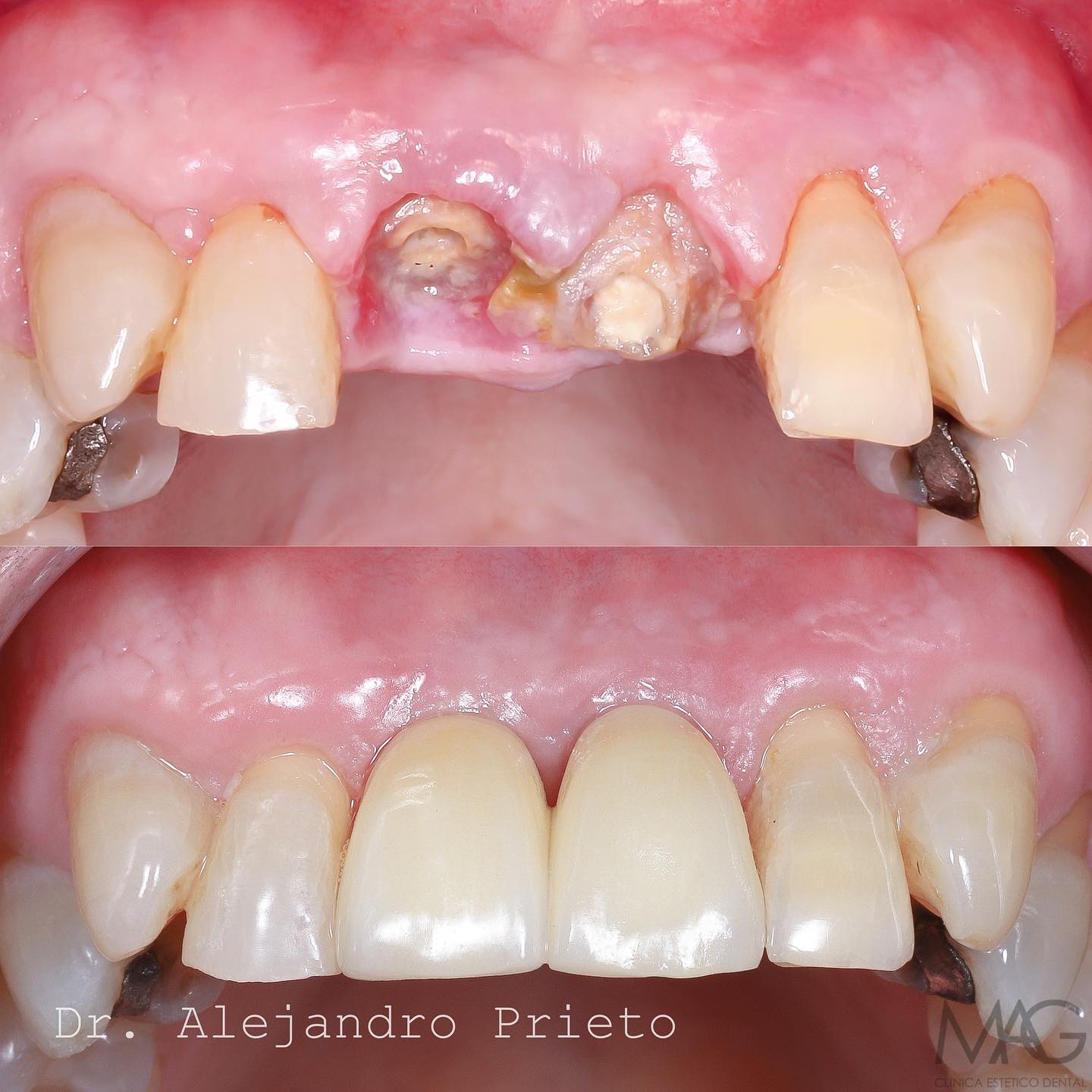 blanqueamiento dental Madrid