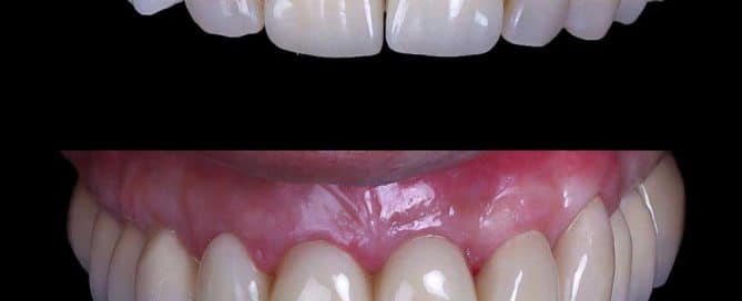 Rehabilitación frente anterior estético / Rejuvenecimiento dental, fotos de antes y después