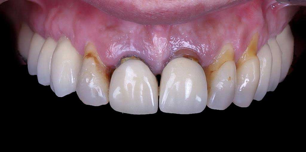 Rehabilitación frente anterior estético / Rejuvenecimiento dental