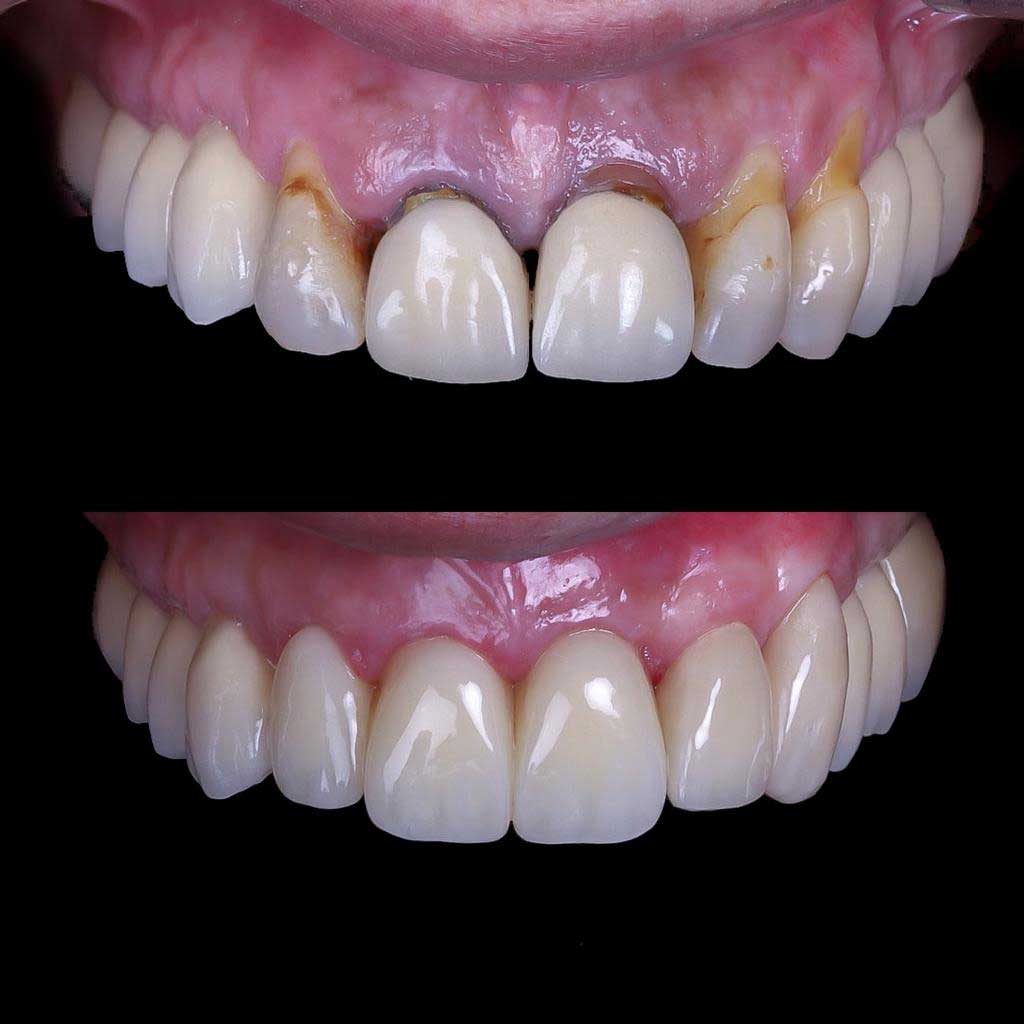 Rehabilitación frente anterior estético / Rejuvenecimiento dental, fotos de antes y después