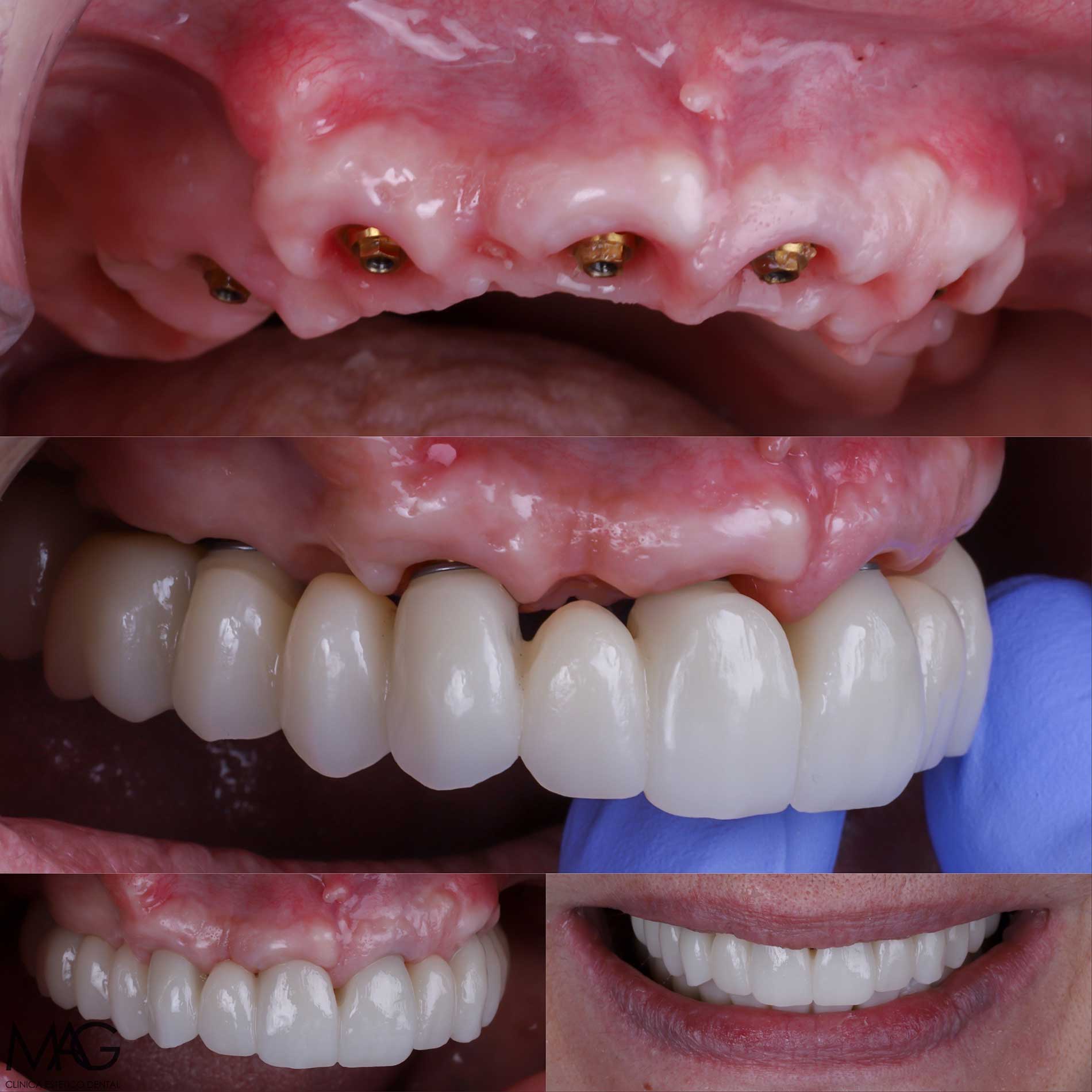 exodoncia e implantes dentales