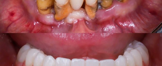 Enfermedad periodontal grave en arcada inferior