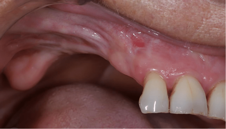 Ejemplo de boca con pérdida de hueso maxilar
